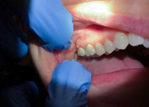 Best Knocked-Out Tooth Emergency  in Aurora, TX